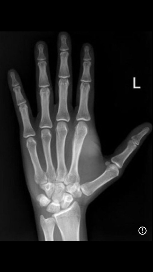 Left Hand X-Ray AP